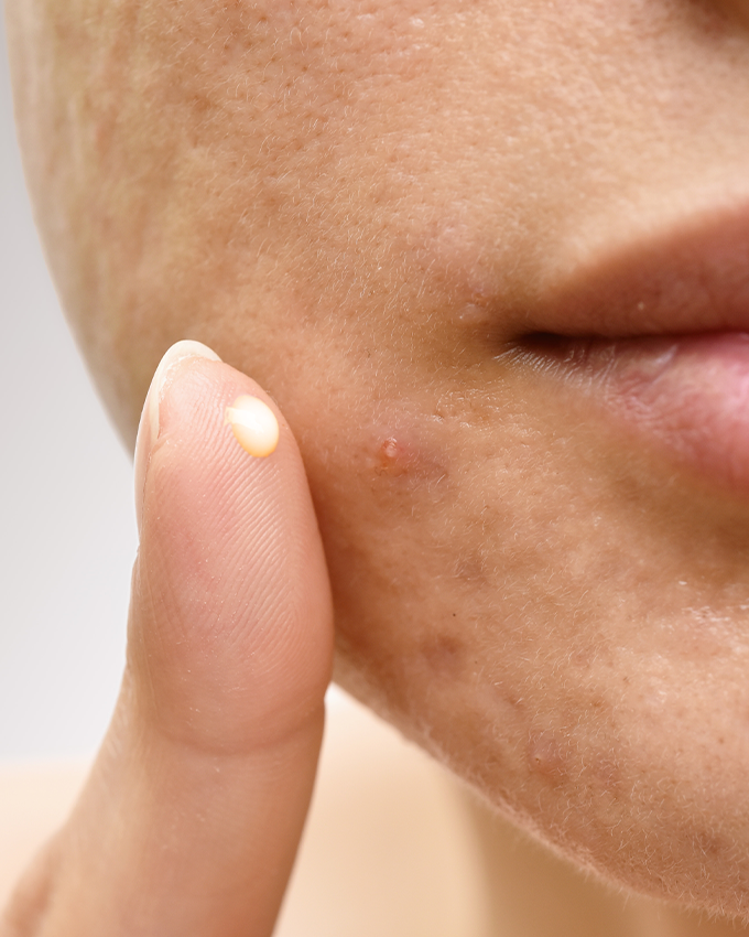 Retinol gegen Aktenarben