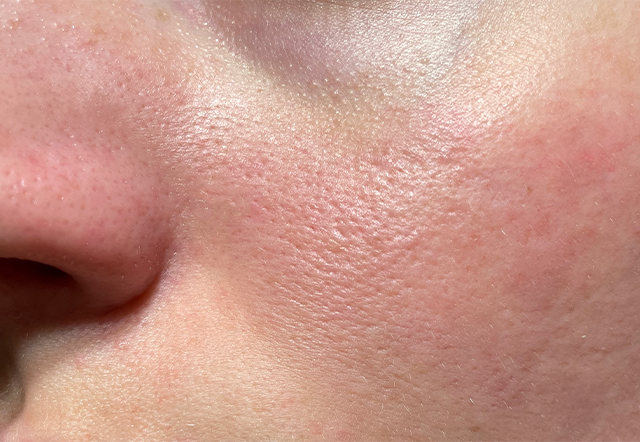 Large pores during menopause