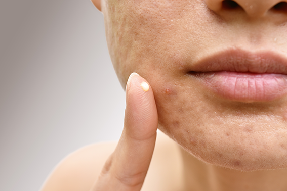 Retinol gegen Aktenarben